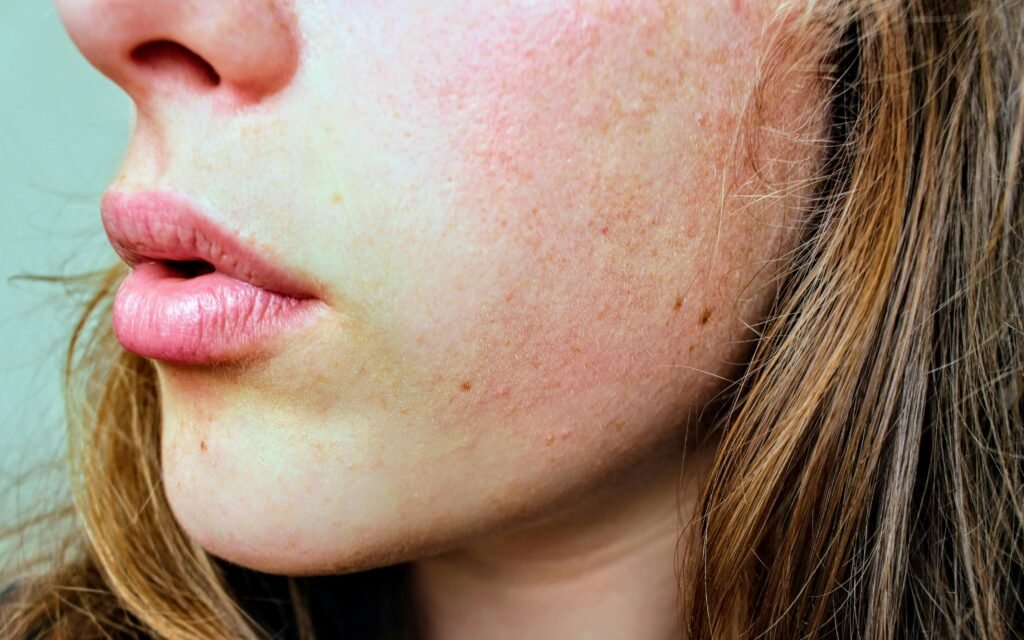 Close-up of a woman’s face with dry skin, highlighting visible dryness, flakiness, and rough patches